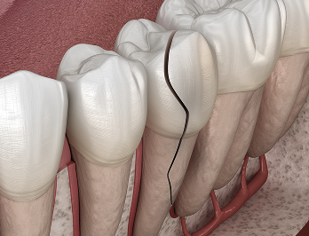 자연치아살리기