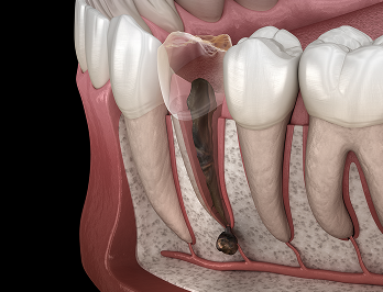 자연치아살리기