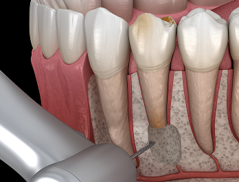 자연치아살리기