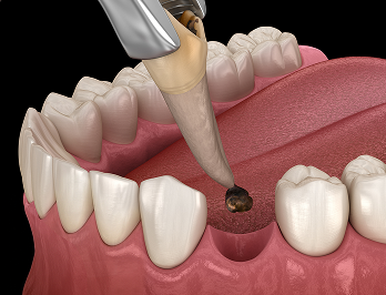 자연치아살리기